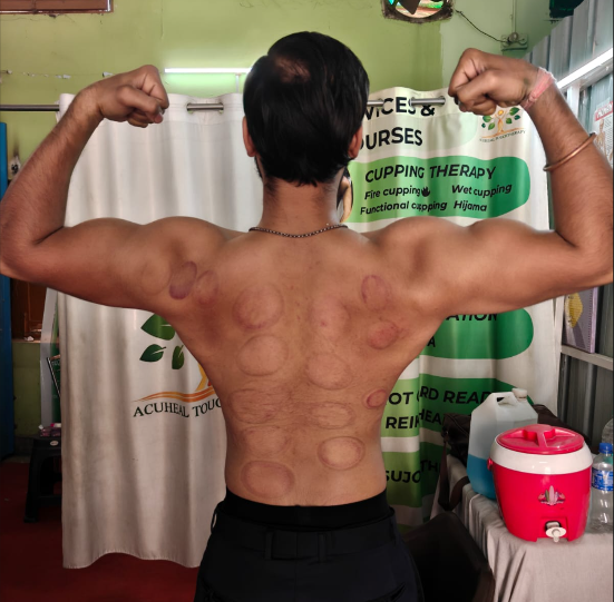Full Back Cupping Results