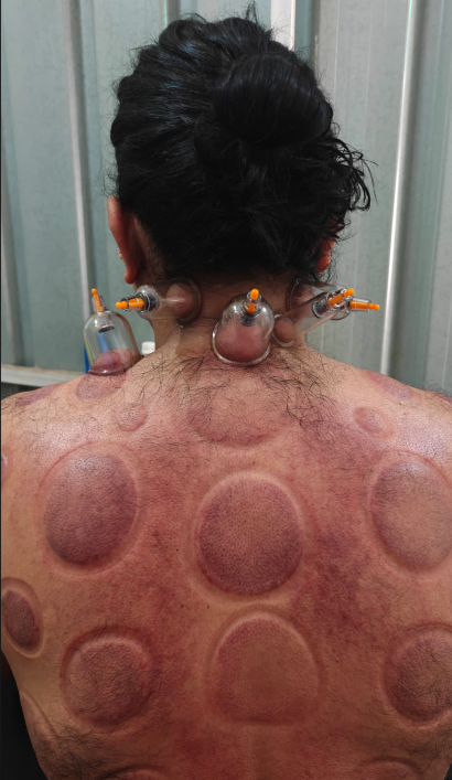 Cervical & Spine Cupping Relief