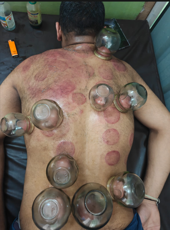 Traditional Cupping Therapy