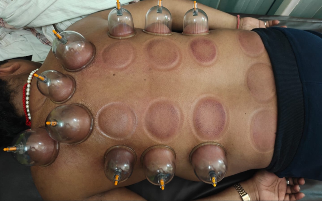 Full Back Cupping Therapy
