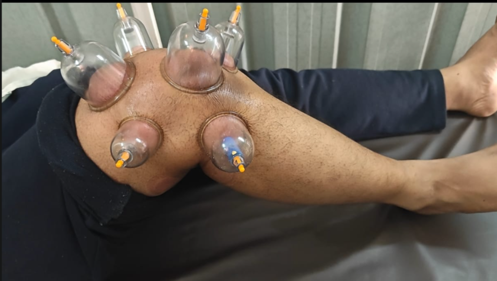 Knee & Joint Cupping Therapy