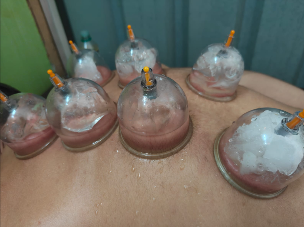 Suction Glass Cupping Session