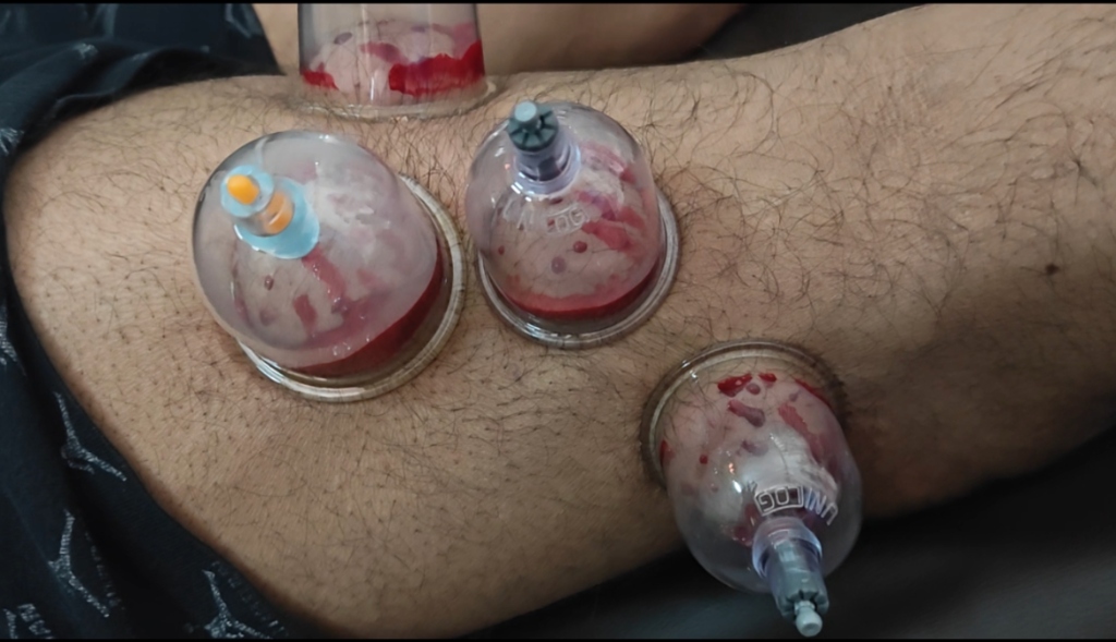 Wet Cupping & Hijama Therapy